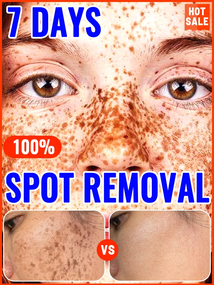 freckle cream，remove freckles，Melasma，dark spots，Hyperpigmentation, Age Spots, Sun Spots, Whitening Light Spots