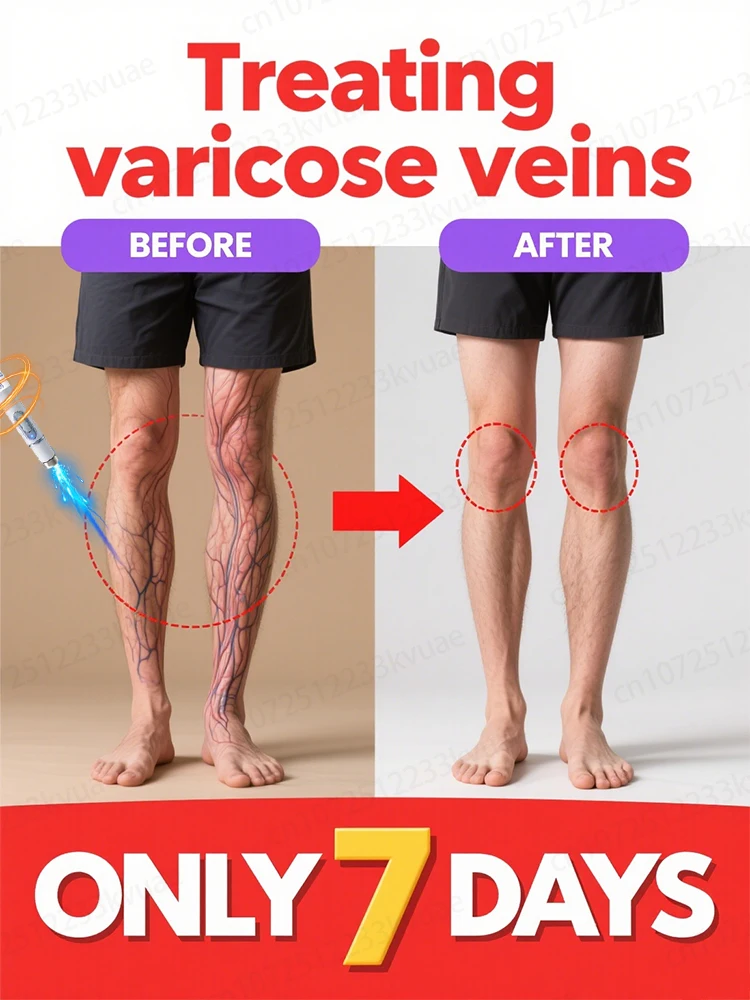 Generatie-2 Laser zegt vaarwel tegen spinnenpoten Spataderen in 7 dagen