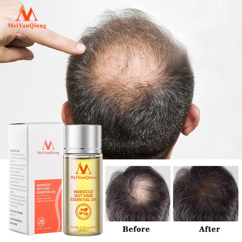 Fast Powerful Hair Growth Essence Hair Loss Products Essential Oil Liquid Treatment Preventing Hair Loss Hair Care Products 20ml