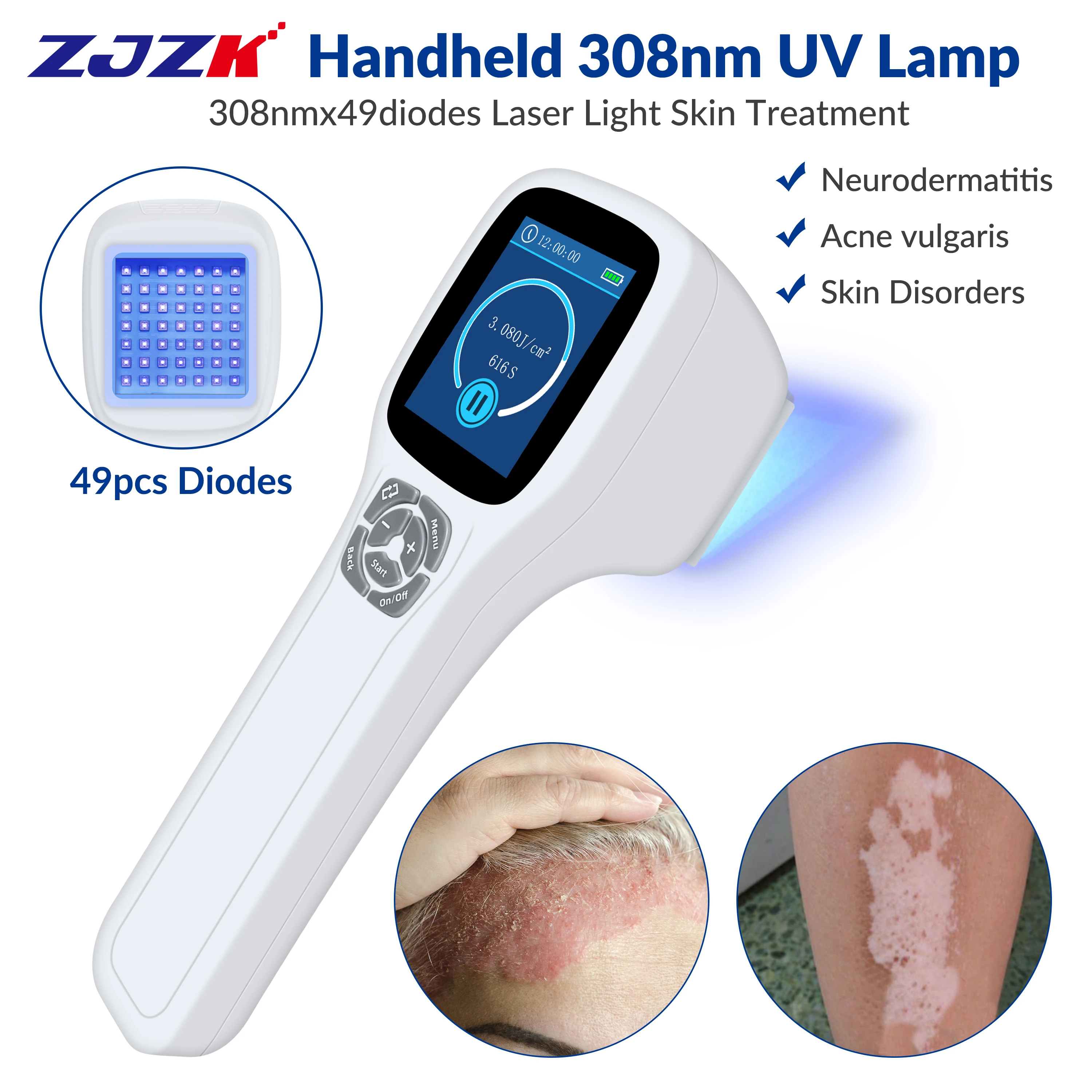 

ZJZK Blue Light Therapy Wand Eczema 308nmx49diodes For Vitiligo Cost Atopic Dermatitis Lymphoproliferative Disease Folliculitis