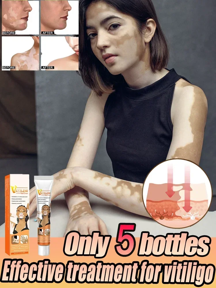 ⁿⁱᶜᵉ Vitiligo cream to eliminate white spots and marks