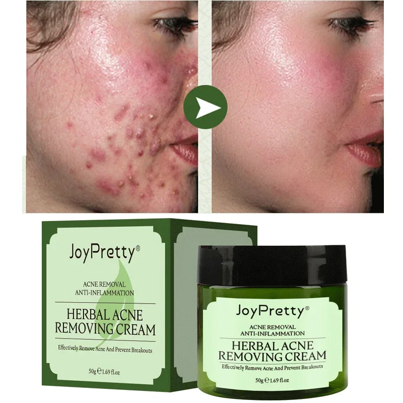 

JoyPretty Herbal Day Cream for Acne Skin Care Face Moisturizer Oil Control Pimple Acne Scar Removal Cream Treatment for Women