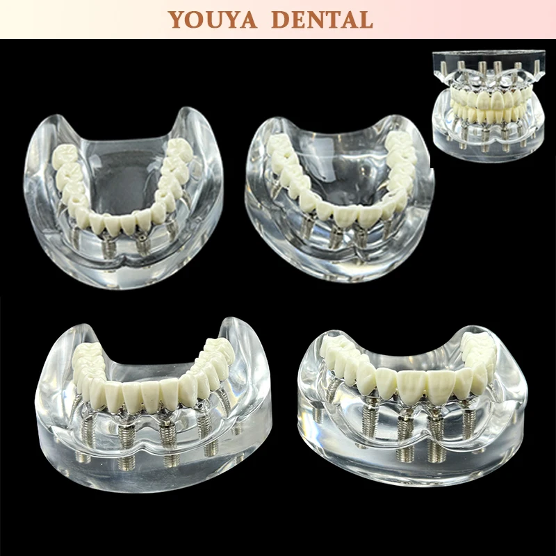 

Dental Model 6 Implants Removable Dental Upper Lower Mandibular Covered Dentures Dental Research Experimental Teaching Mode