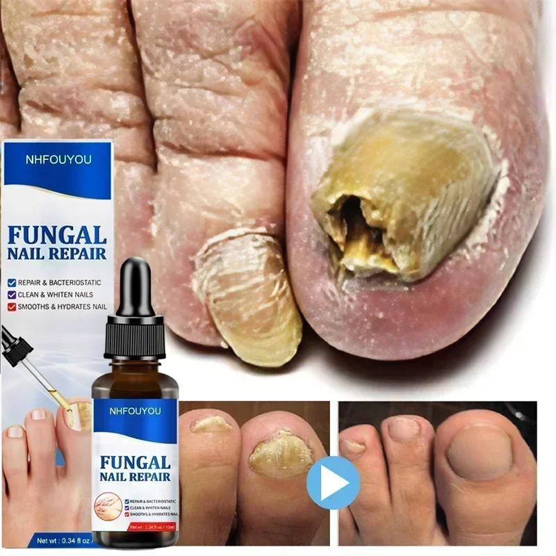 Aceite para tratamiento de uñas por hongos, esencia para reparación de pies, Gel para eliminación de hongos en las uñas de los pies, crema antiinfección, 10ML