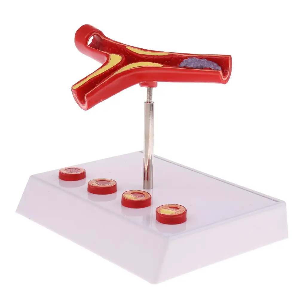 Human Vessel Thrombus Model Cross Section Anatomical Statue PVC Educational Lab Supplies for Medical Training