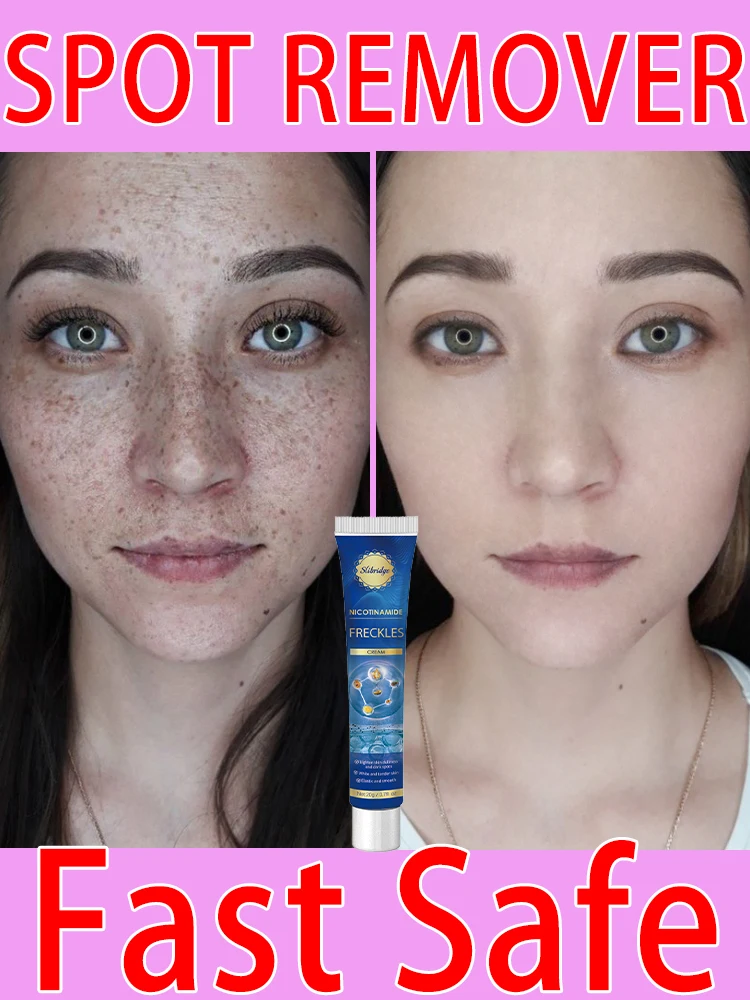 

Sun Age Dark Spot Freckles Chloasma