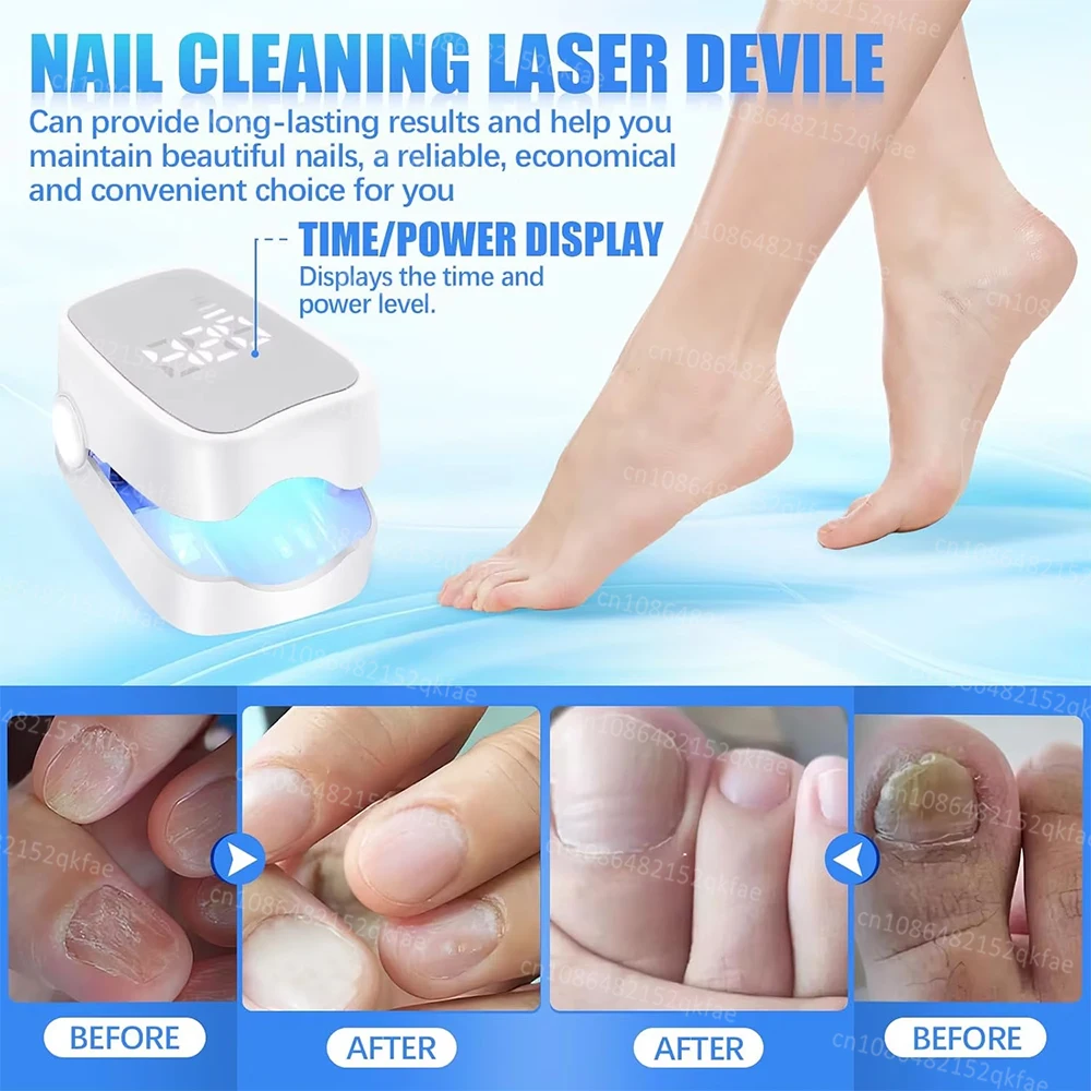 Nail Fungus Treatment LED Laser Device for Cleaning Onychomycosis USB Charge 905nm Infrared Light 470nm Blue Light Nail Salon