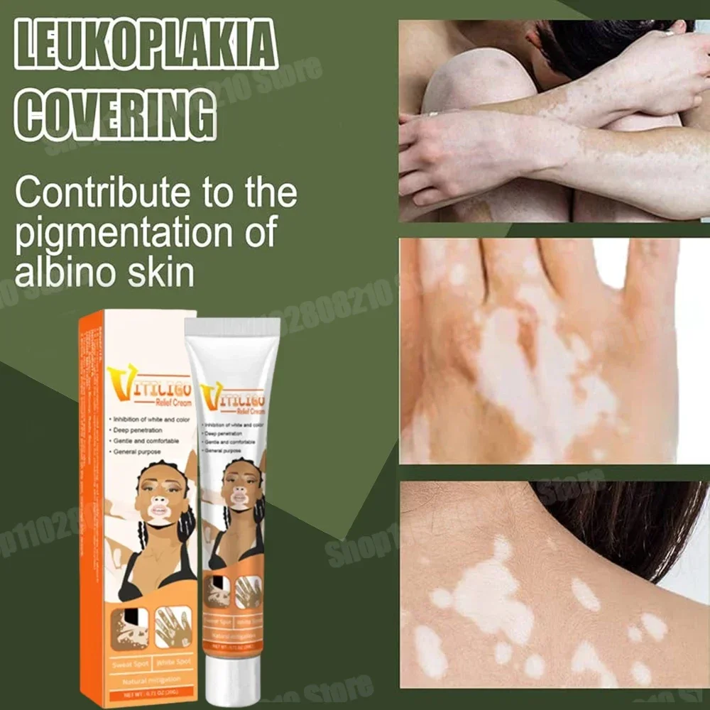 ᴴᴼᵀ Vitiligo Removal Cream White Spot Care Cream Skincare cream vitiligo skin Sweat spot Reduce white spots Skin care