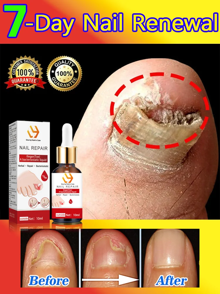 Foot Nail troubles Solved completely