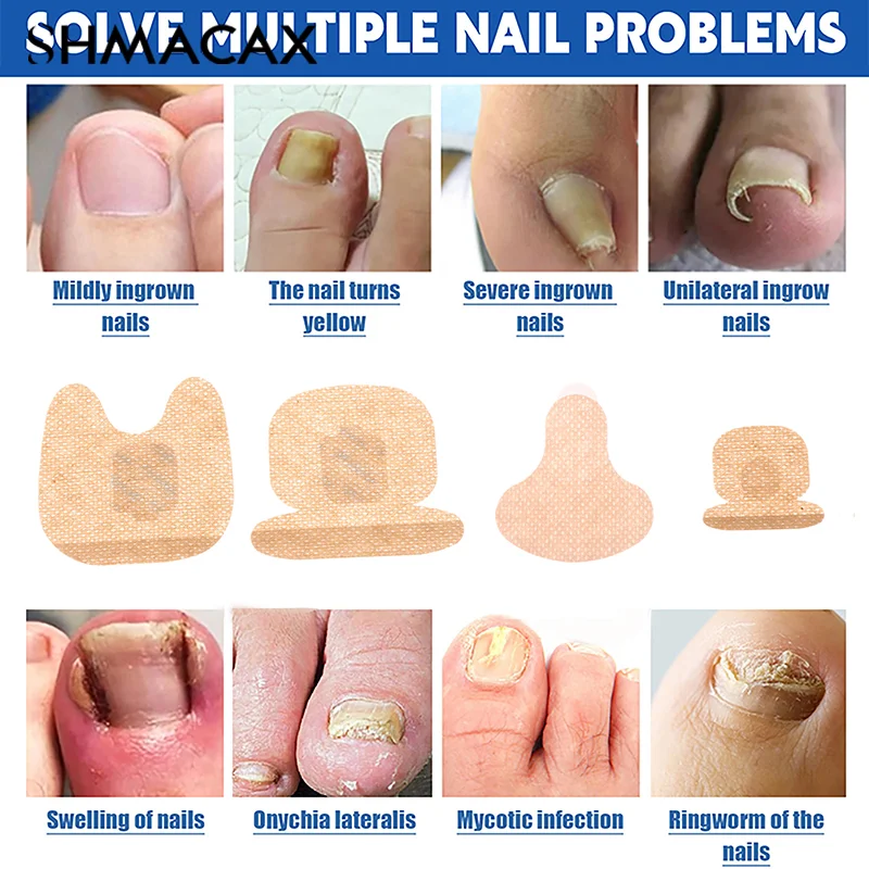 رقعة العناية بالأظافر ، رقعة إصلاح الأظافر ، الأظافر الرمادية الفطرية ، سماكة ، علاج بارونيشيا الناعم ، ملصق تصحيح مضاد للعدوى