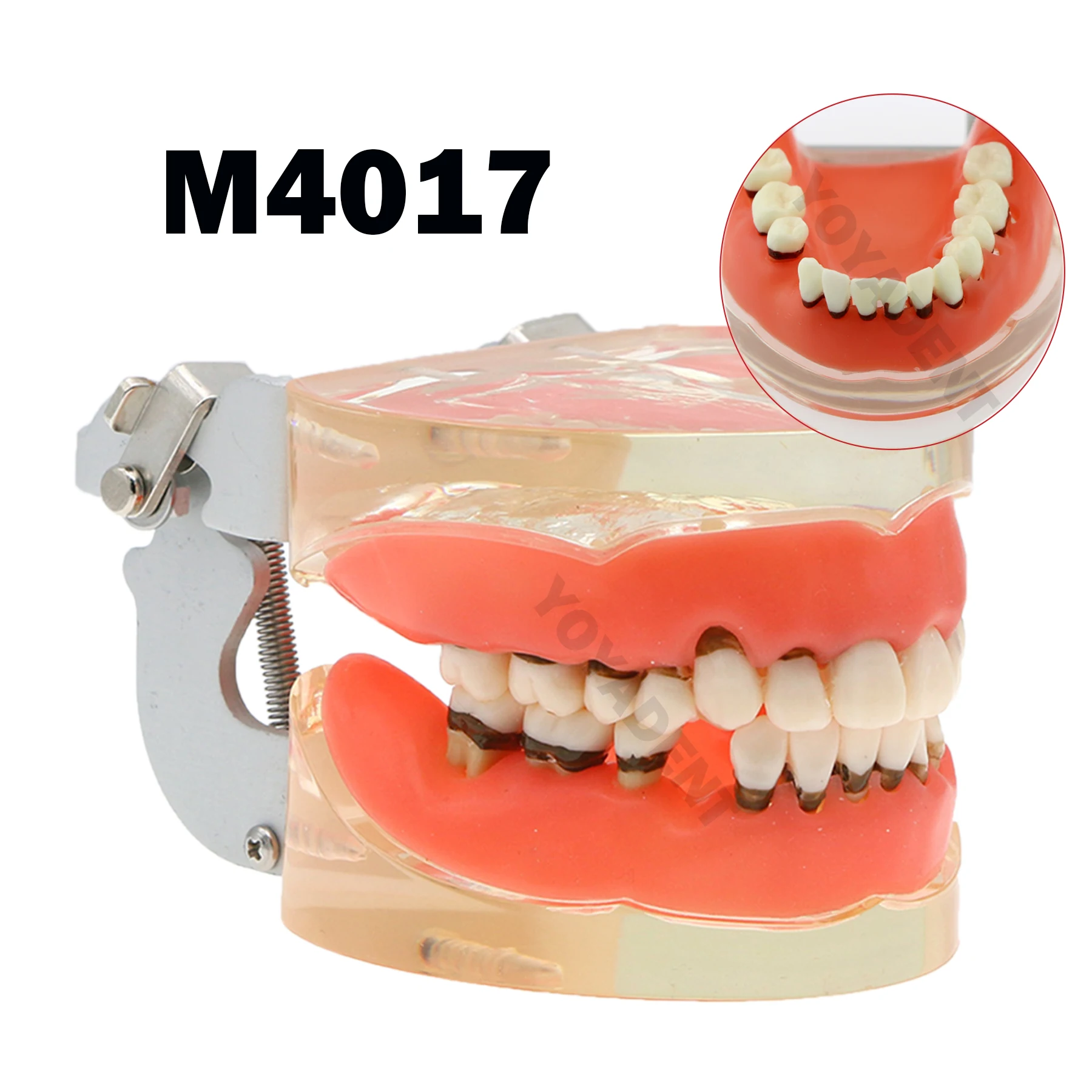 

Стоматологическая патологическая модель, обучающая модель из смолы для лечения заболеваний пародонта, демонстрационные аксессуары M4017