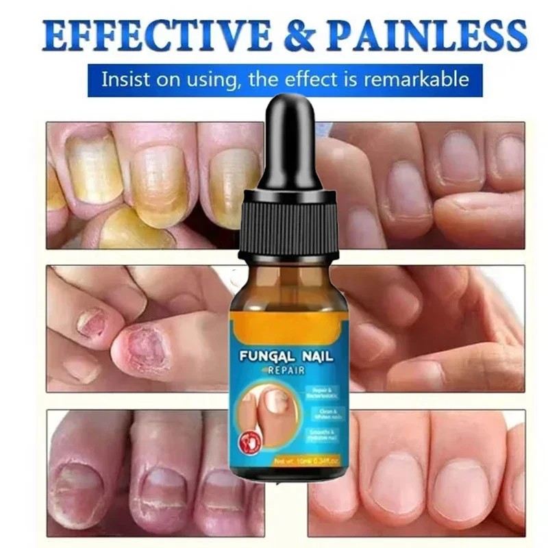 Effective Fungal Nail Treatments Nail Repair Oil Toe Repair Essence Powerful Anti Infection Cream for Fungal Nail Treatment