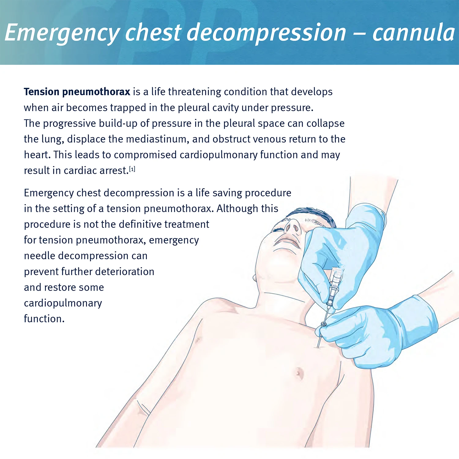 Sanke Rescue Pneumothorax Nadel Trauma Medical Ifak Brustkatheter Nadelkatheter 50g Nadel Dekompression Edc Erste-Hilfe-Set – Detail 2