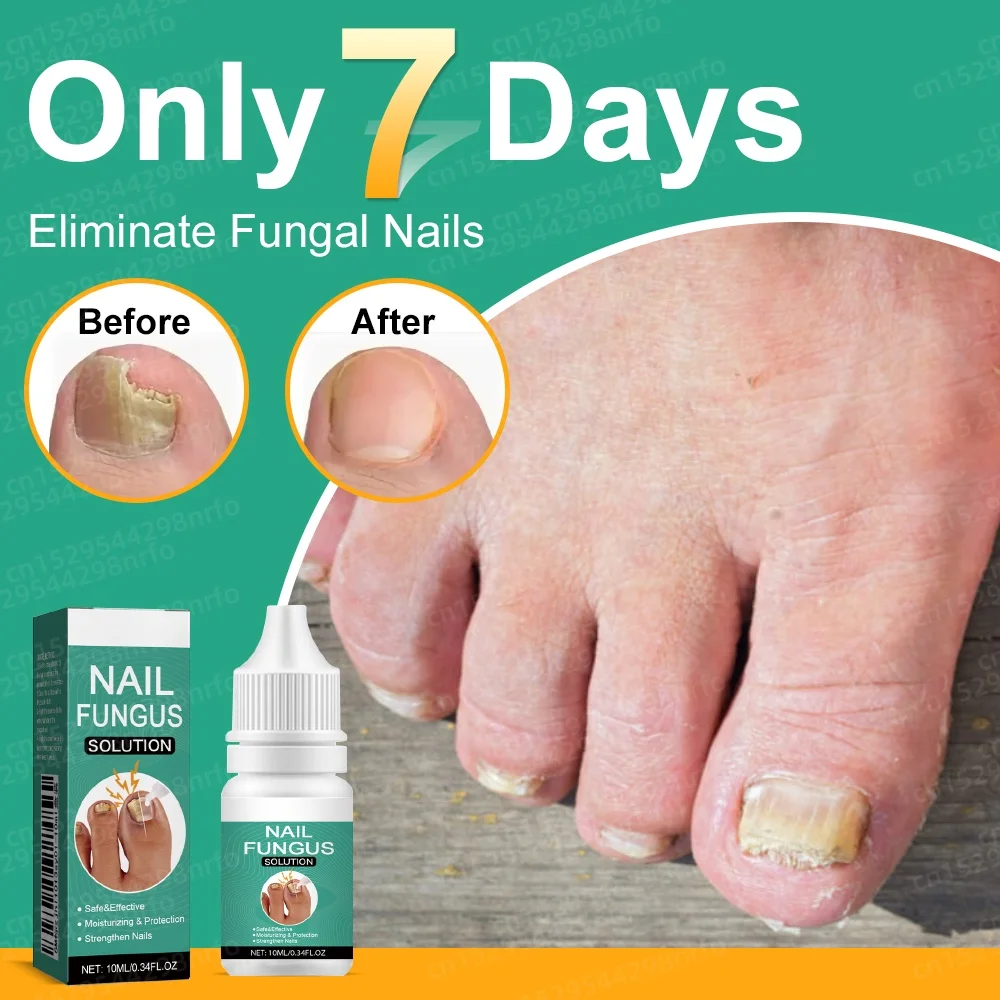 Óleo essencial para tratamento de unhas fúngicas, resolve problemas de fungos nas unhas dentro de 7 dias