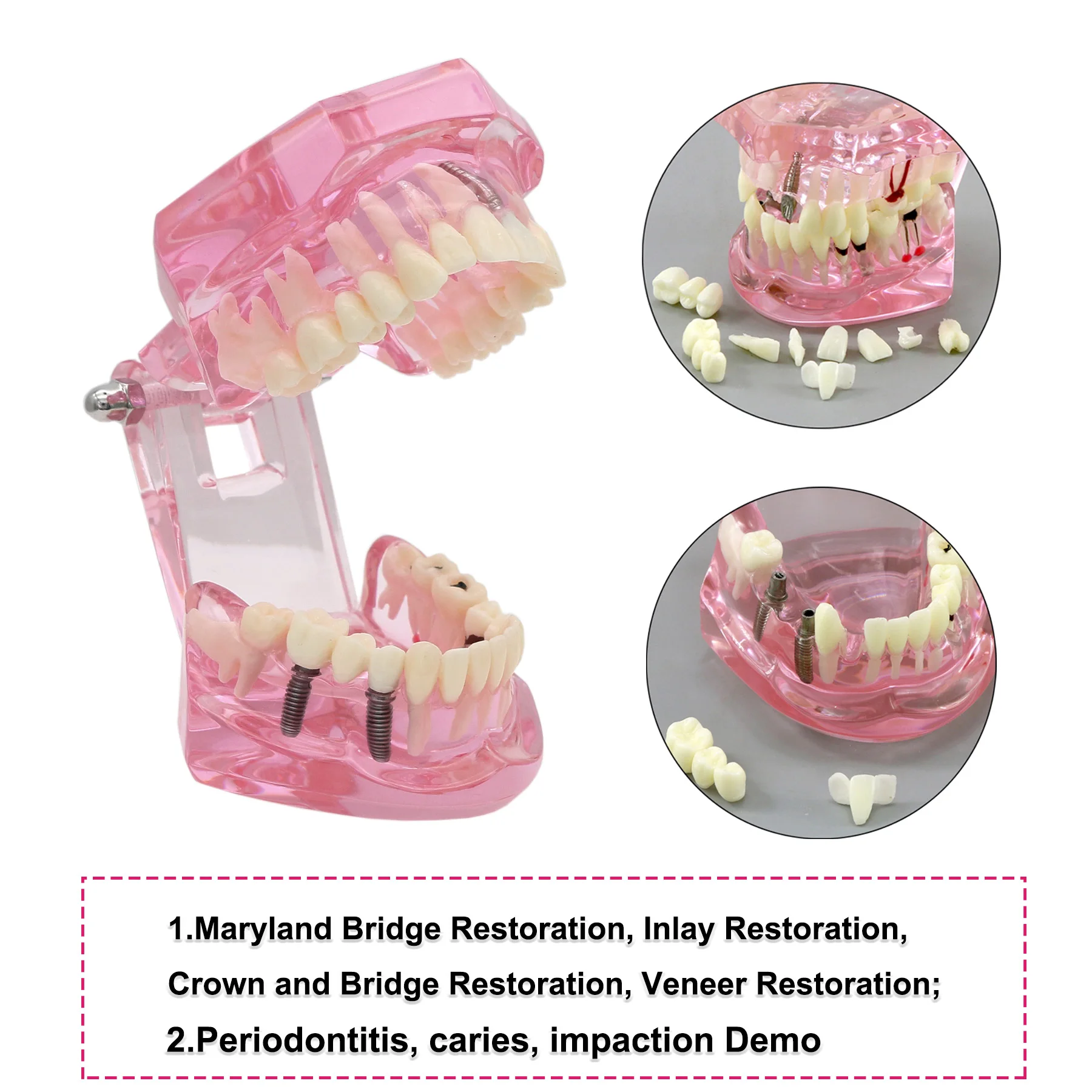 

Standard Dental Model Teaching Model Implant Restoration Model For Dentistry Teaching Studying Pathology Demo