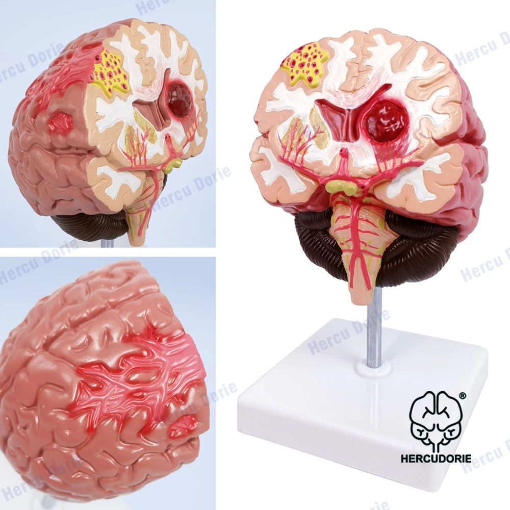 

Human Brain Anatomy Brain Pathological Disease Brain Pathological Structure Brain (vascular) Lesion Brain Model