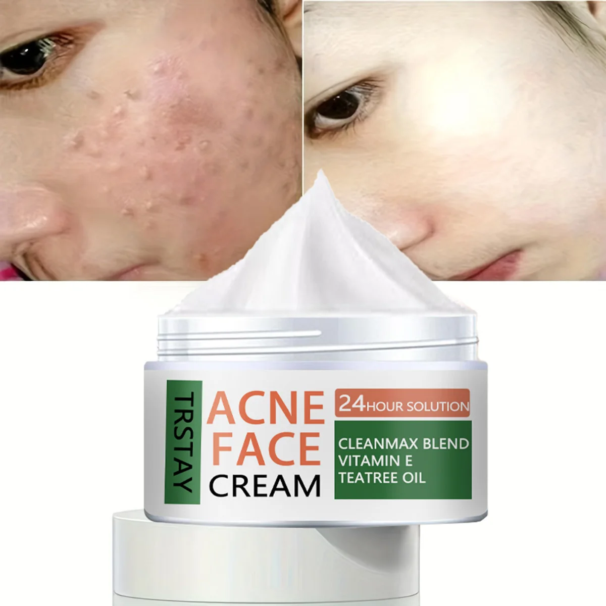 ACNE FACE CREAM, Firming, Moisturizing, And Beautifying Neck Cream, Moisturizing And Brightening Skin Tone, Neck Mask