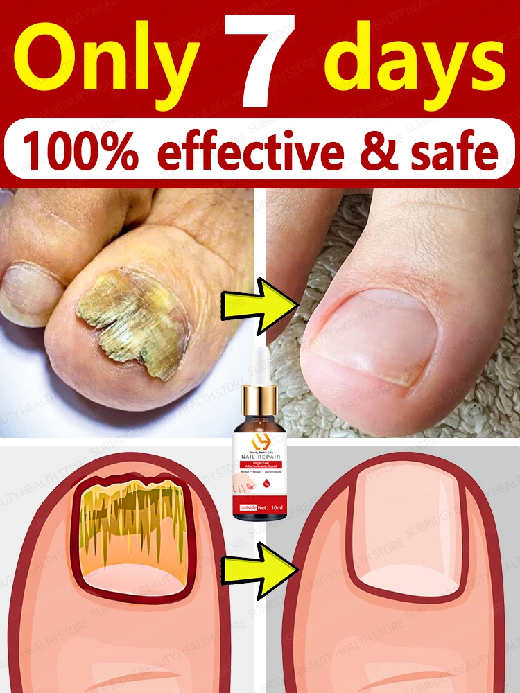 Minyak esensial perbaikan onikomikosis menyelesaikan semua masalah kuku