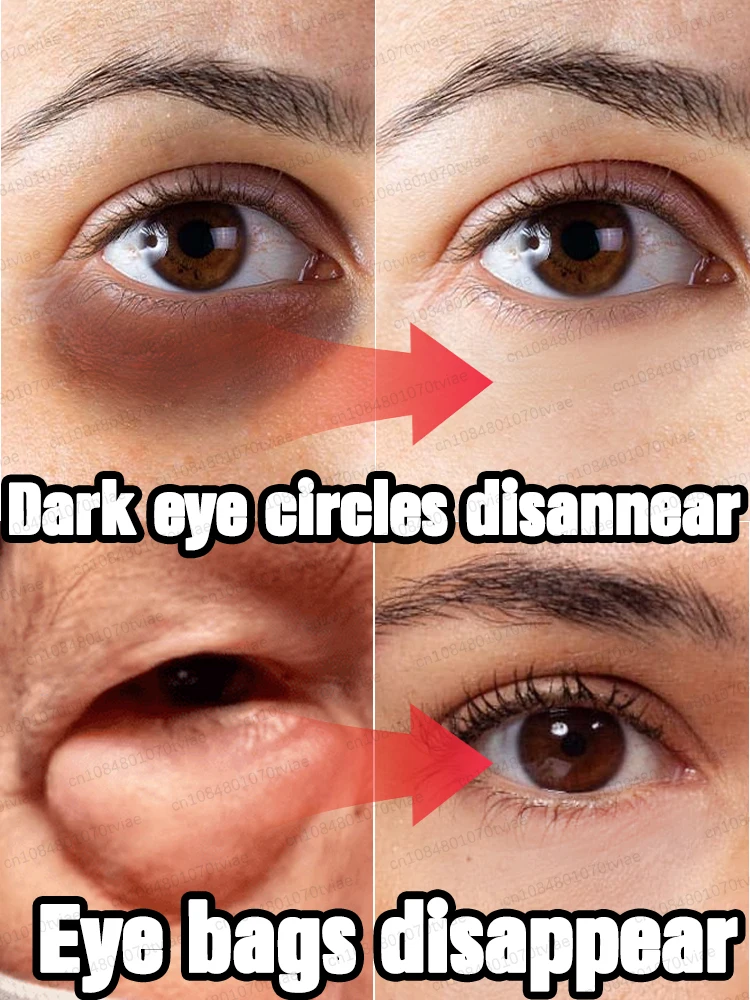 Why do we need to improve eye bags? Eye bags make you look old, dark circles make you look tired and affect your appearance