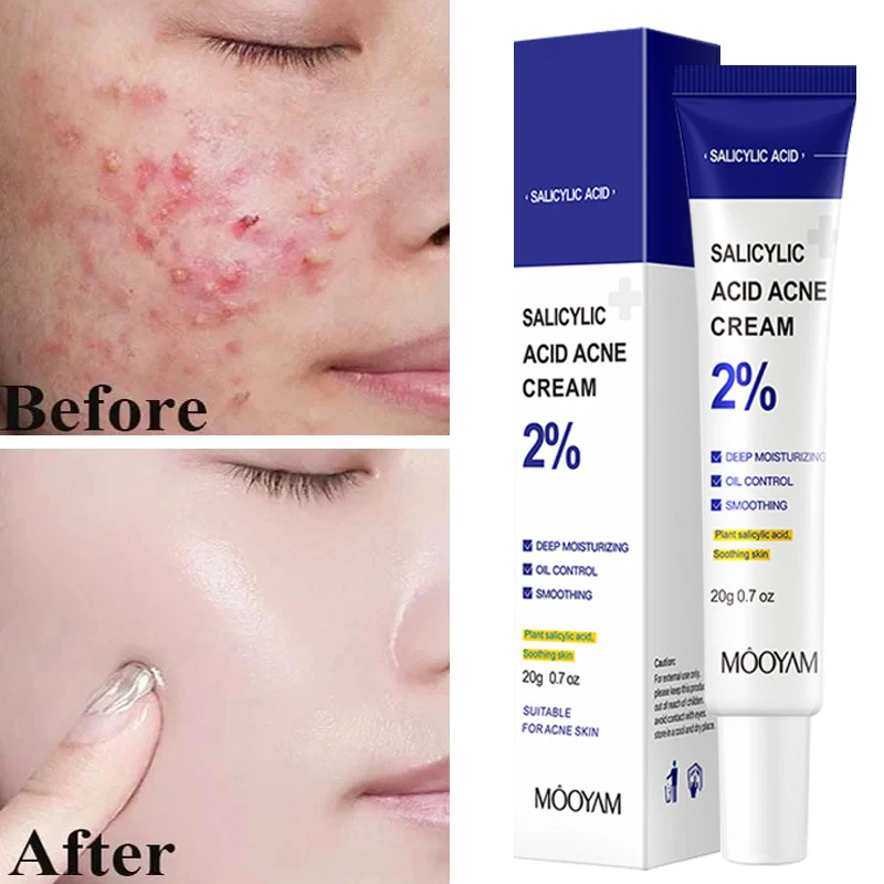 Salicylic Acid Acne Skincare Treatment Cream Remove Deep Acne Scars Gel Oil Control Shrink Pores Blackheads Care Exfoliator