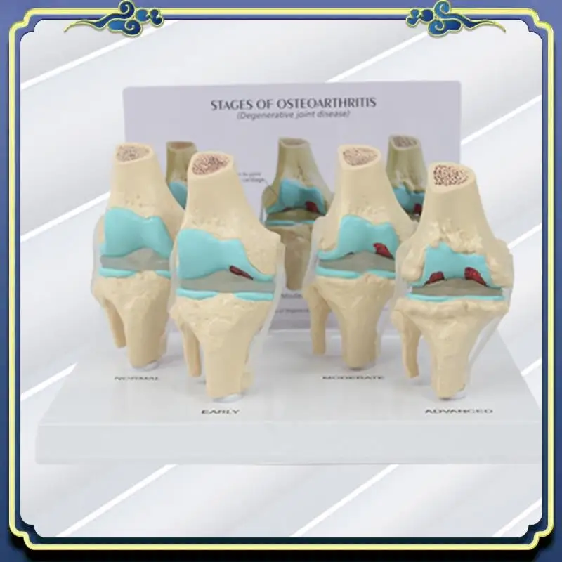 Portable Knee Kit Osteoarthritis Anatomy Model With Educational Key Card 4 Stage Knee Model Orthopedic Teaching Aids
