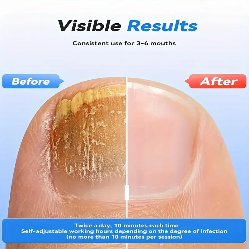 

1/2/4 Pcs Nail Fungus Light Device for Multiple Fingernails & Toenails