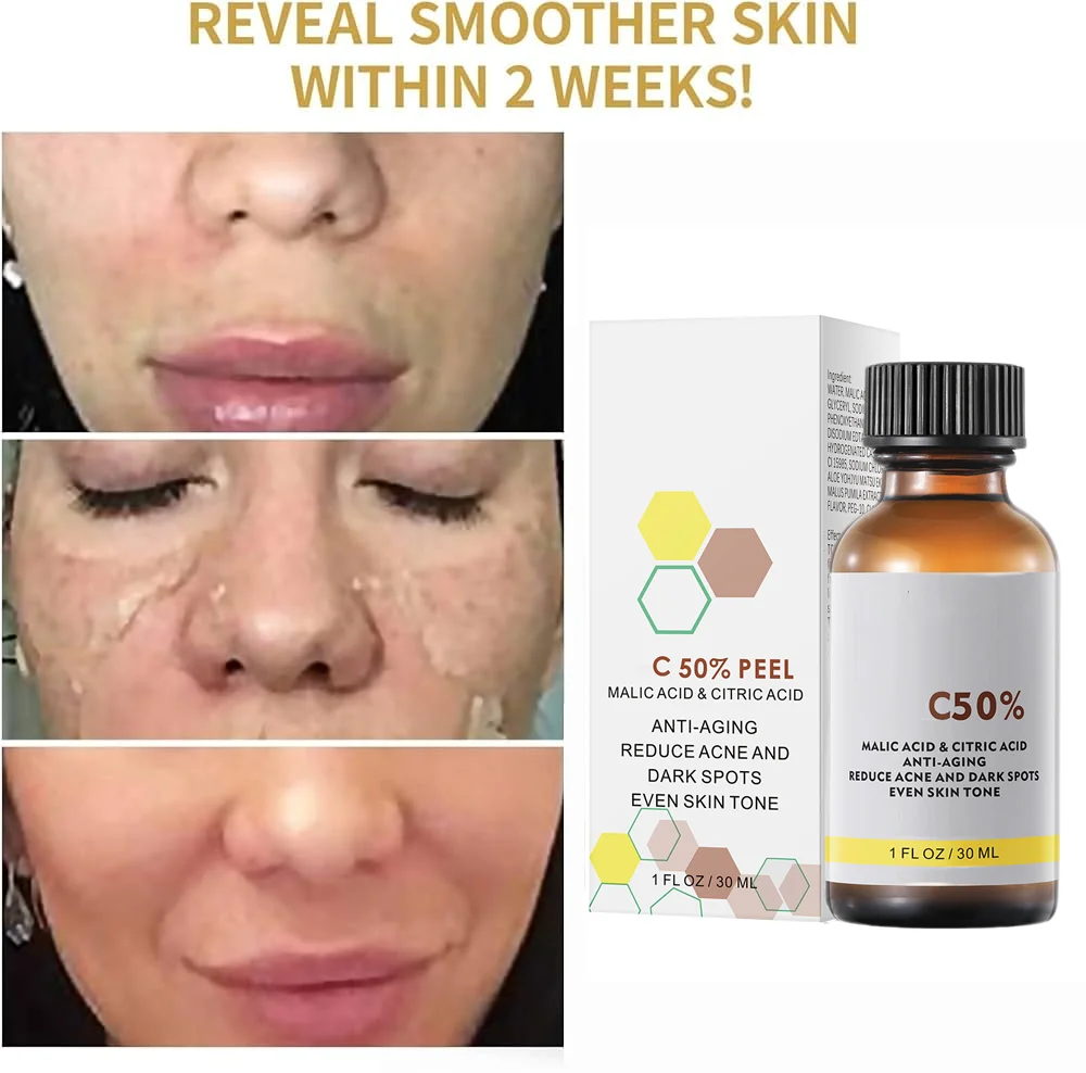 Avec acide malique et acide citrique pour le visage Peel 40% Sérum Peeling Peeling Sérum Peeling Peel chimique Essence nourrissante blanchissante
