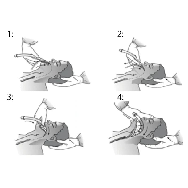 Califed Silicone Reinforced Laryngeal Mask Airway Double Lumen Laryngeal Mask High Quality LMA