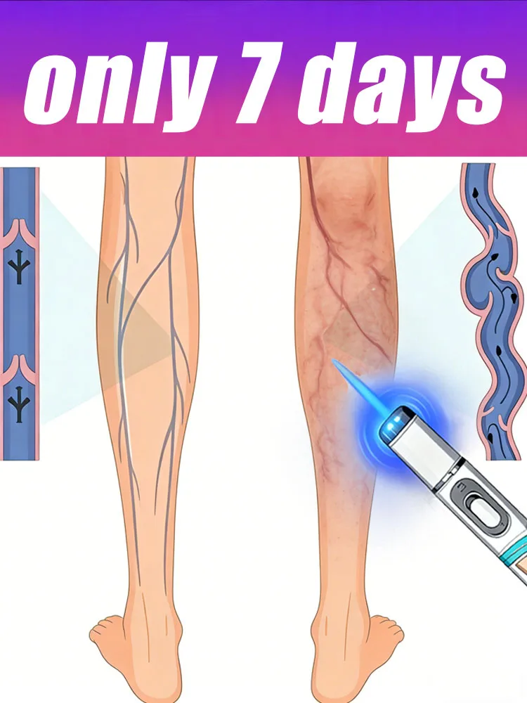 The blue light pen is a best-selling leg care tool that helps you say goodbye to leg discomfort.