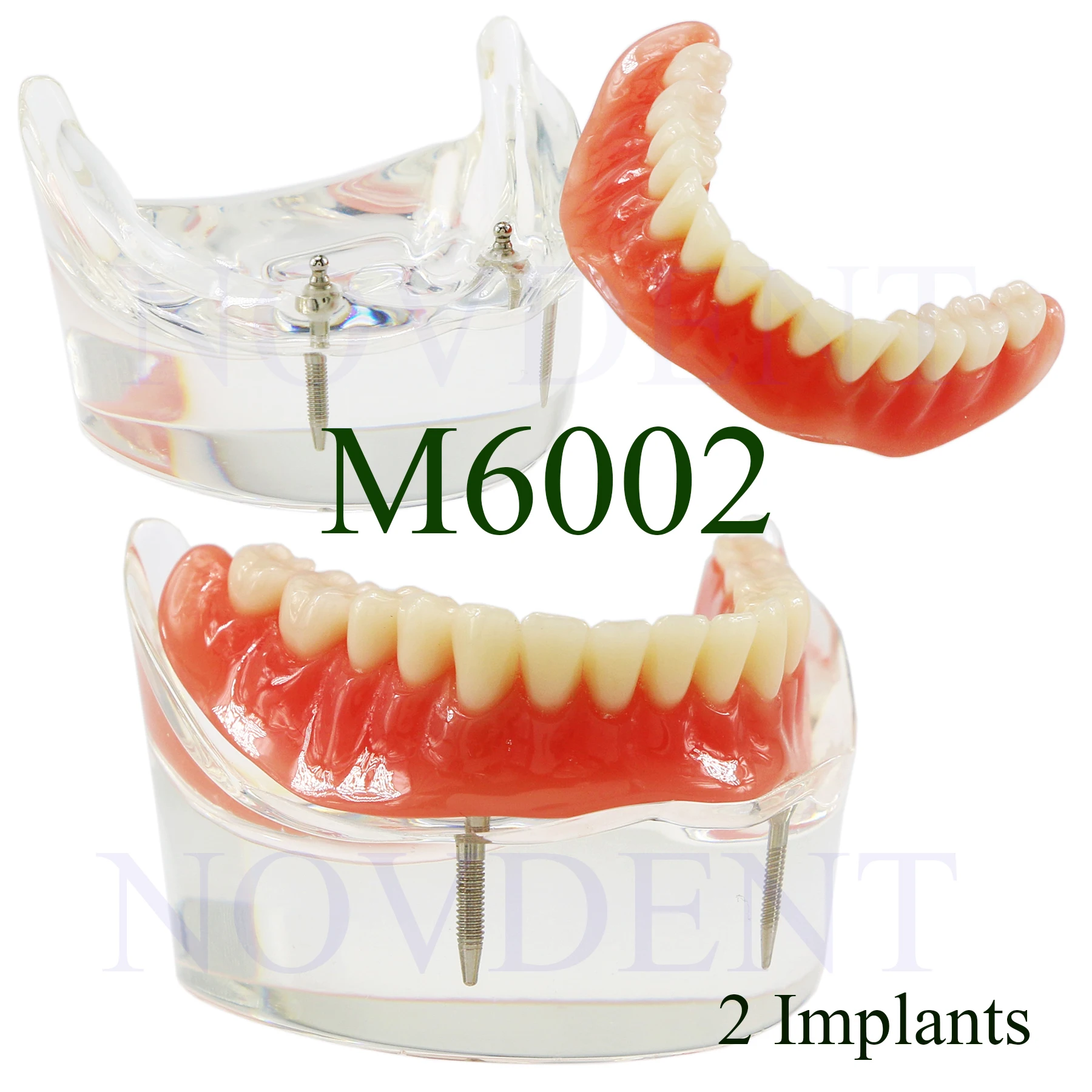 Dental dolna szczęka 2 implanty Model odbudowy Overdenture Model 2 implanty mosty edukacja badania nauczanie Student M6002