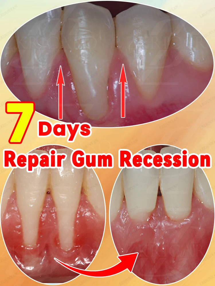 

Healthy gums, no more gum recession