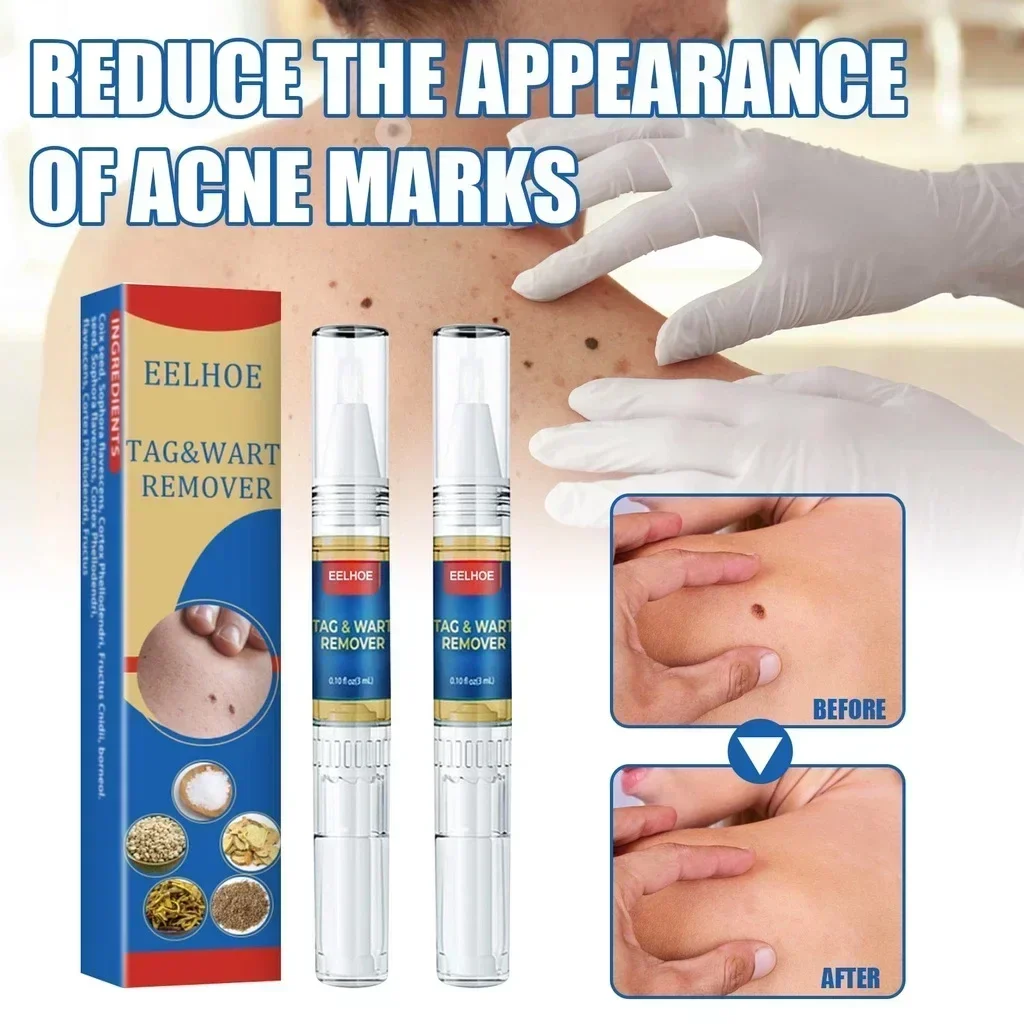 Wart Remover Pen Auto Skin Tag Mole Removal Kit Cleaning Pen Face Skin Care Body Dot Treatments Remover Beauty Health