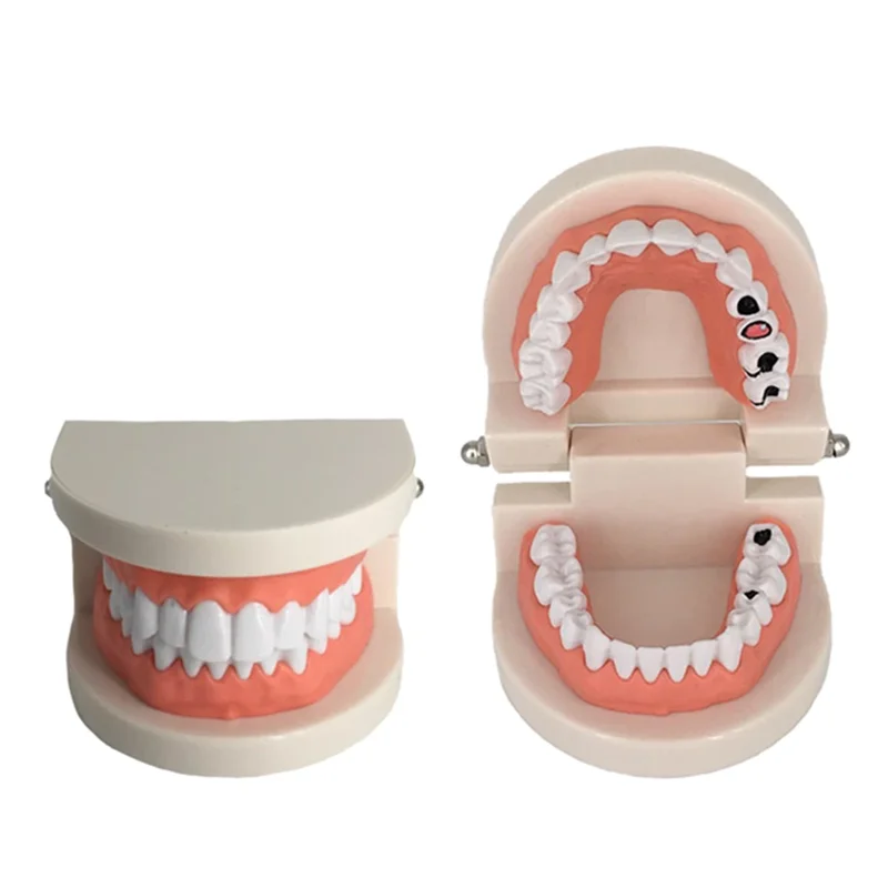 Dental Education Model With Caries Tooth Standard Teeth Model Dentist Teaching Study Typodont Brushing Teeth Demonstration Tools