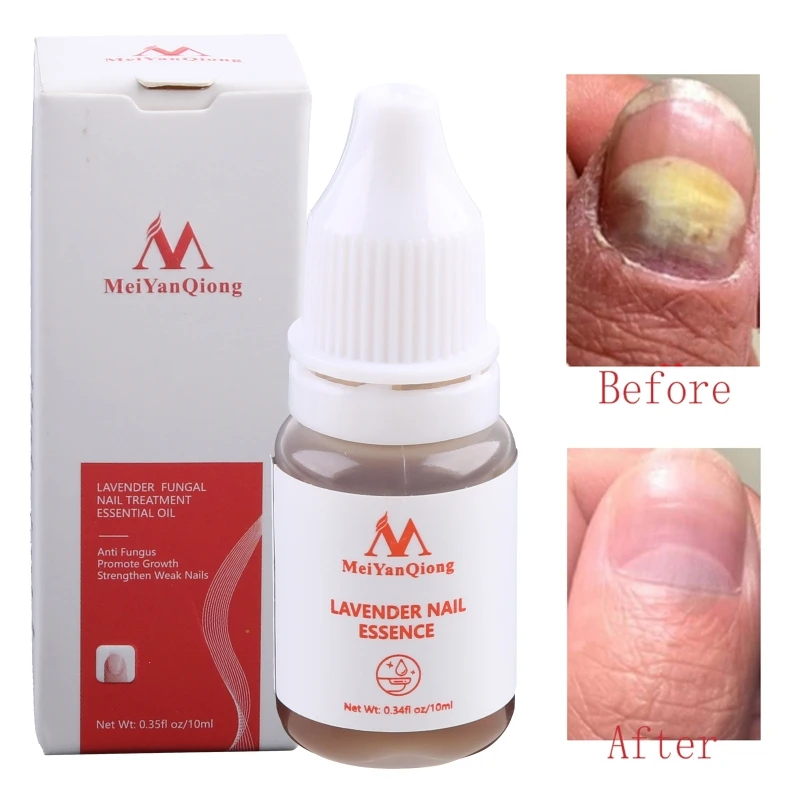 Repair Essence Serum Onychomycosis Removal Toe Dropship