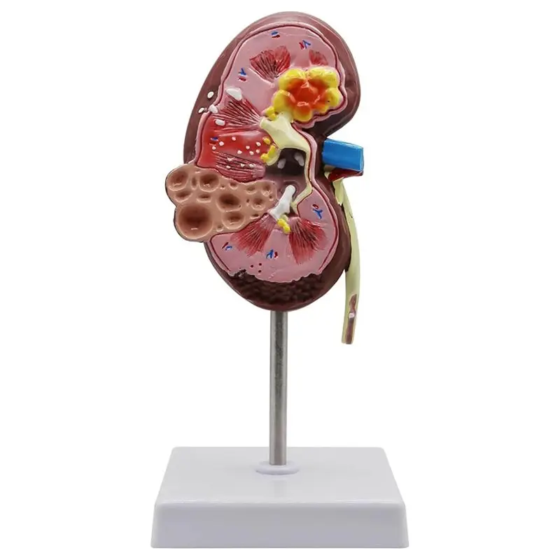 ABJF-Pathological Kidney Model Kidney Diseases Model Urology Model