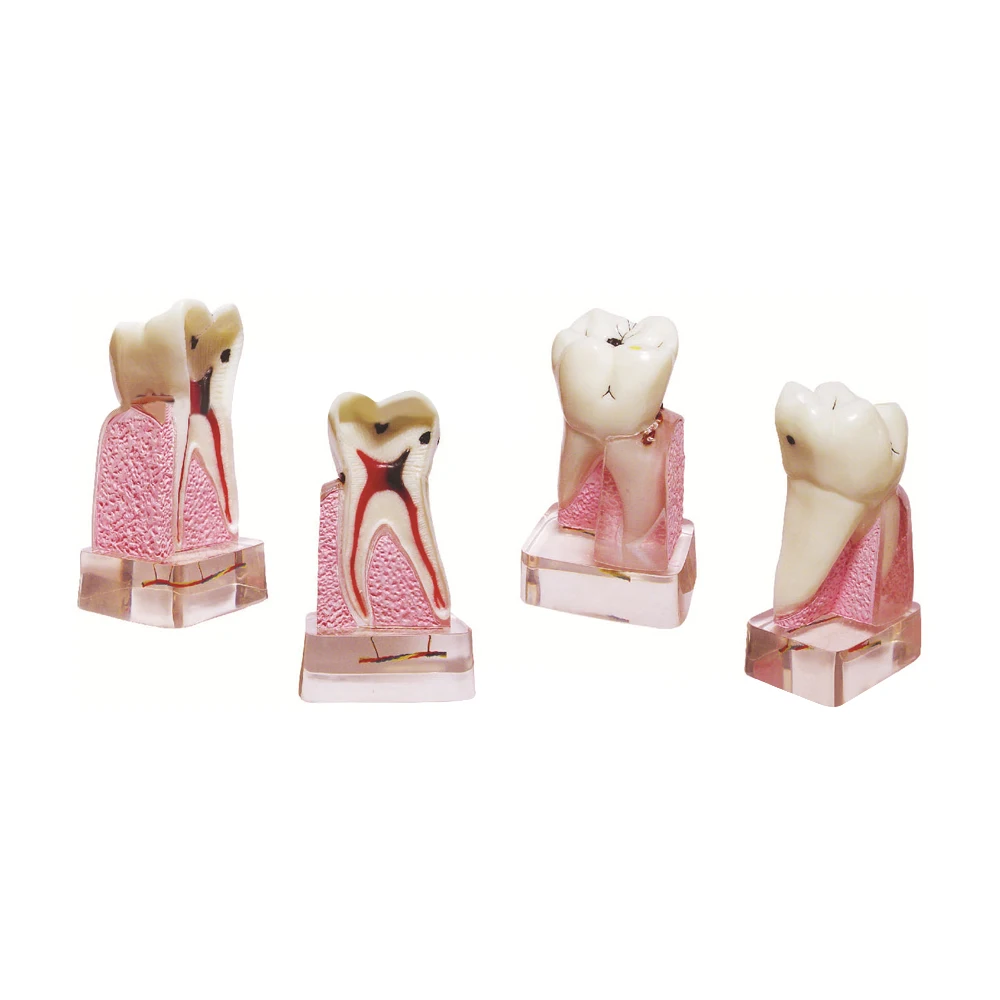 Dental Pathological Model, 4x Magnified Anatomical Teeth Model, Eco-friendly PVC, Medical Educational Supply, Lab Tool