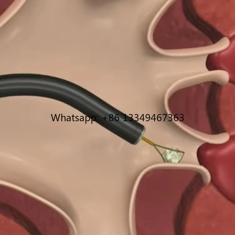 

CE Certified Urological Stone Extraction Basket for Anorectal Surgery Equipment