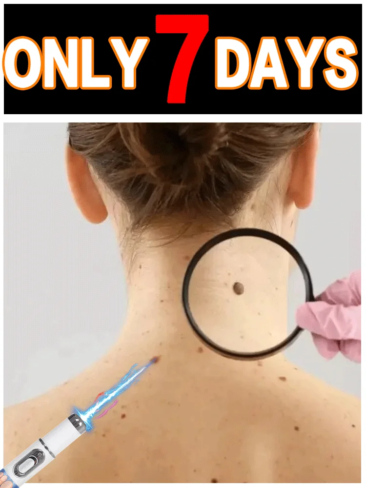 أداة إزالة ثآليل القلم الأزرق القوية، مريحة وسهلة الاستخدام.