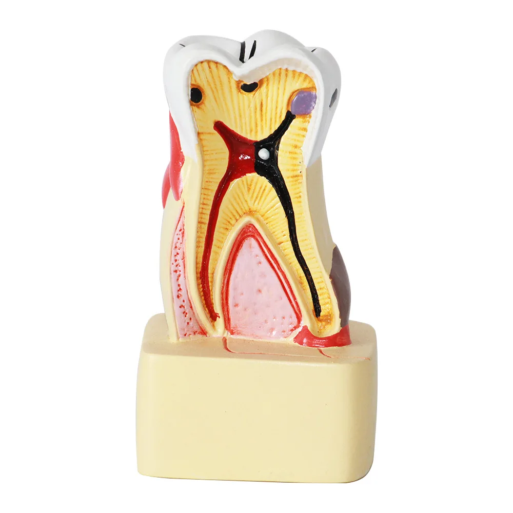 Human dental model, oral care and health model, dental caries anatomical model