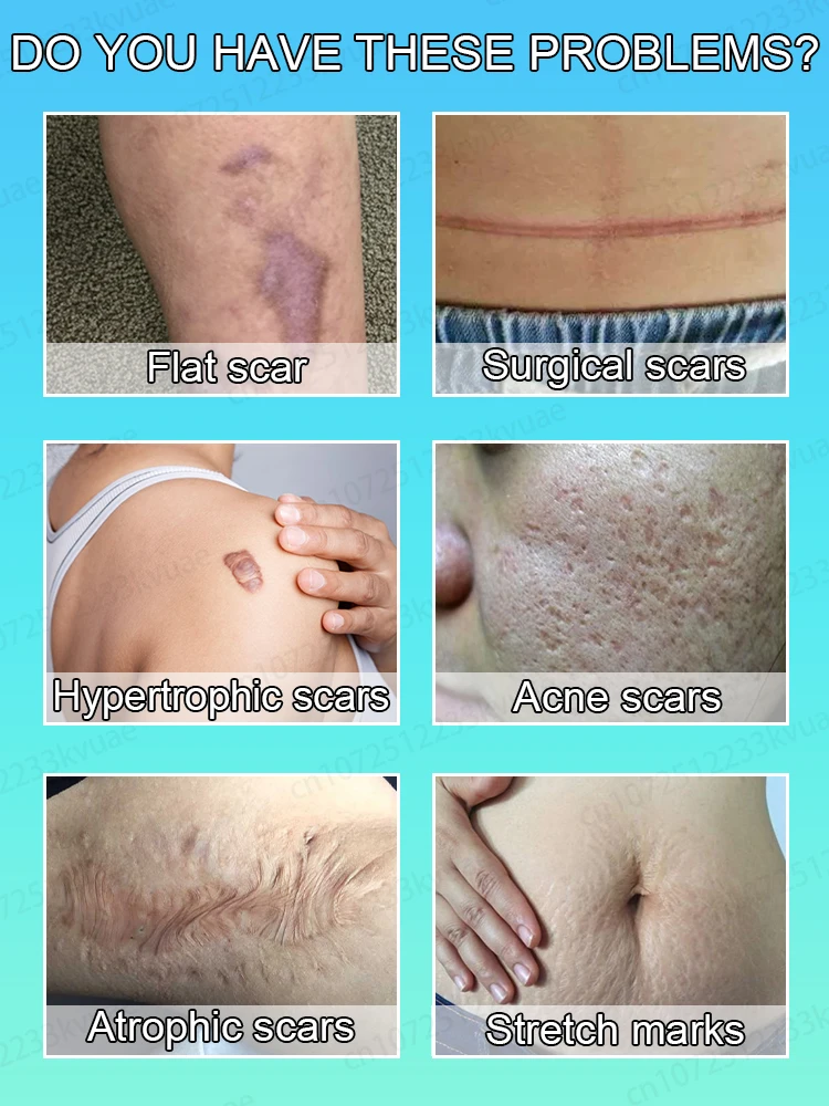 Laserlittekenverwijdering, geschikt voor alle soorten littekens, veilige en gezonde littekenverwijdering