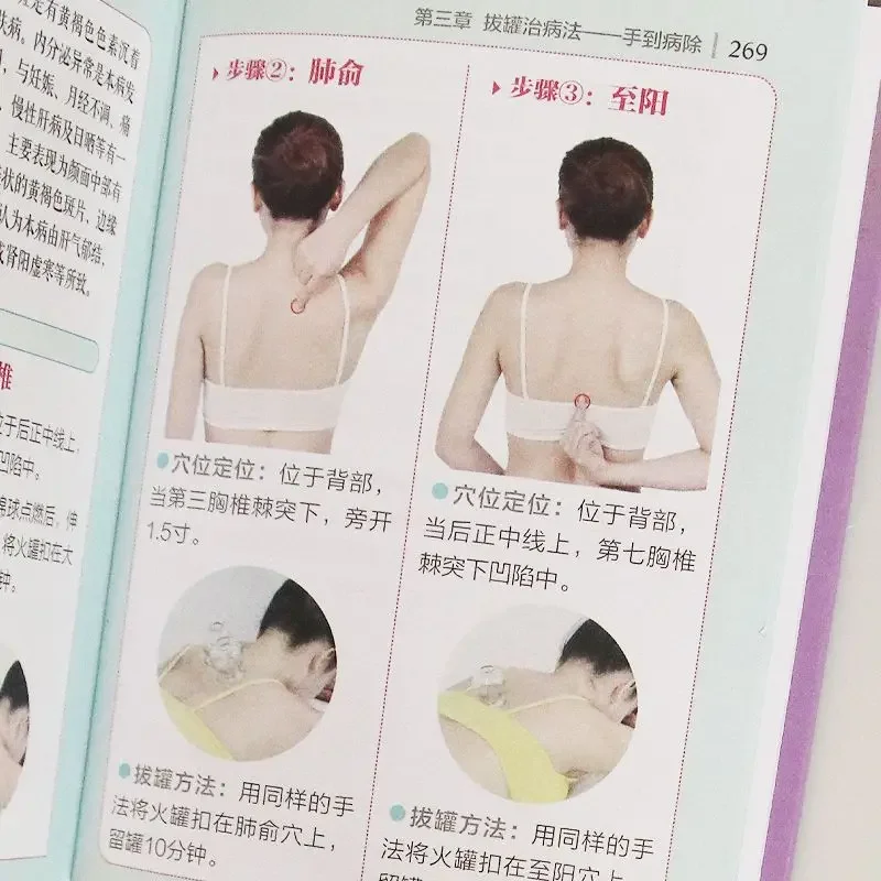 Symptomatic cupping TCM health book, illustration of human meridian acupuncture points, symptomatic cupping, zero basic learning