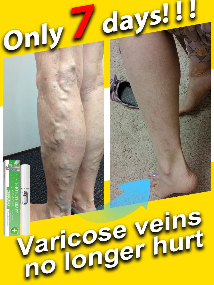 

Powerful Laser Therapy for Moderate Varicose Veins, Relieve Pain and Improve Circulation for Both Men and Women