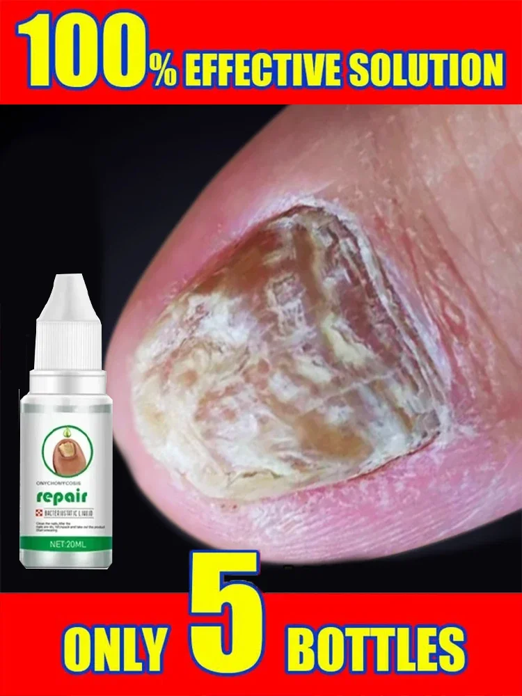 

Fungal Nail Treatment Oil Foot Repair Essence Toe Nail Fungus Removal Gel Anti Infection Cream Fungal Nail Removal