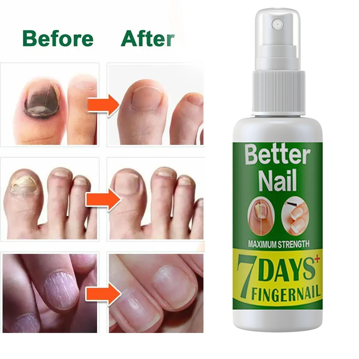 Fungal Nail Repair Spray Nursing Treatment Foot Nail Fungus Removal Gel Anti-Infective Paronychia Onychomycosis Care