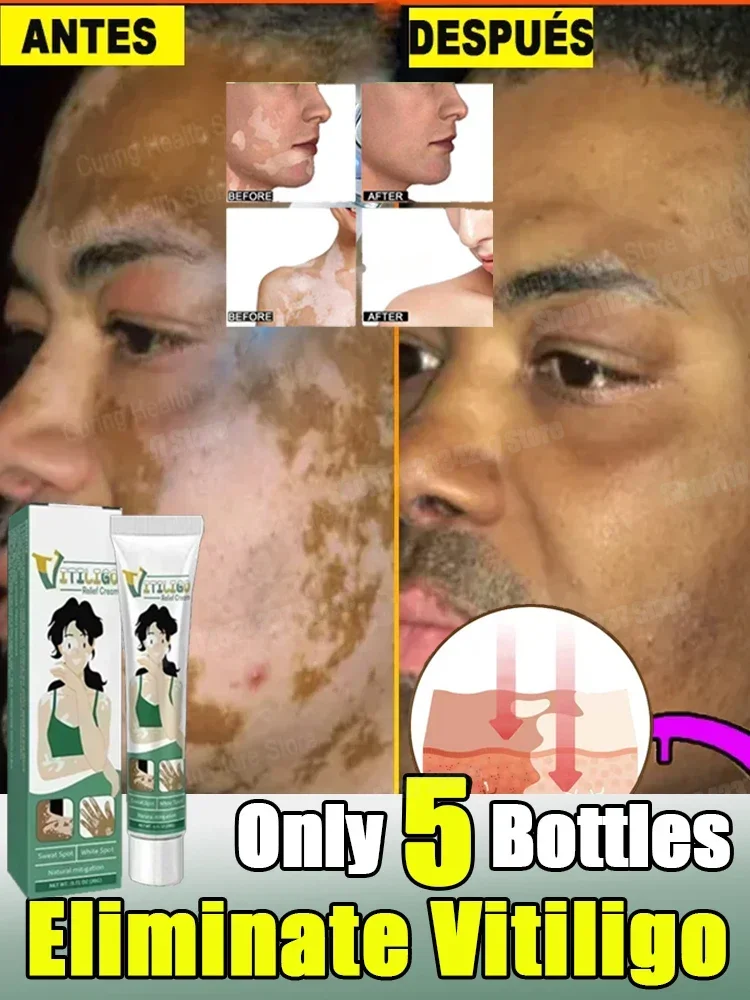 Vitiligo Organics for White Spots Skin Repair Pigmentation