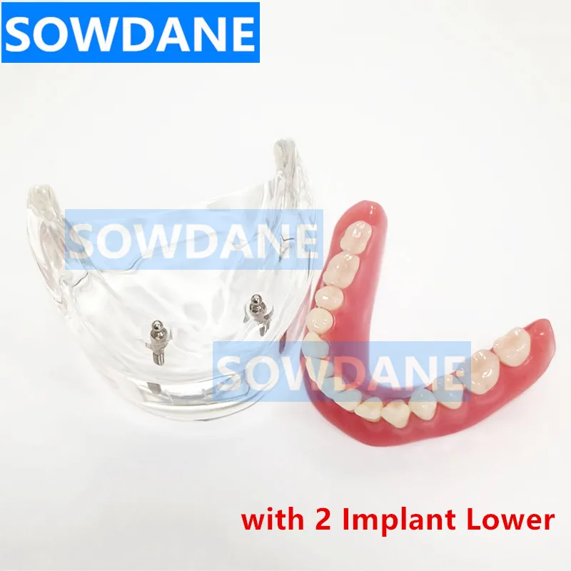 1 piece Dental Overdenture Interior Mandibular Lower with 2 Implant Restoration Teeth Study Teach Model Dental Model