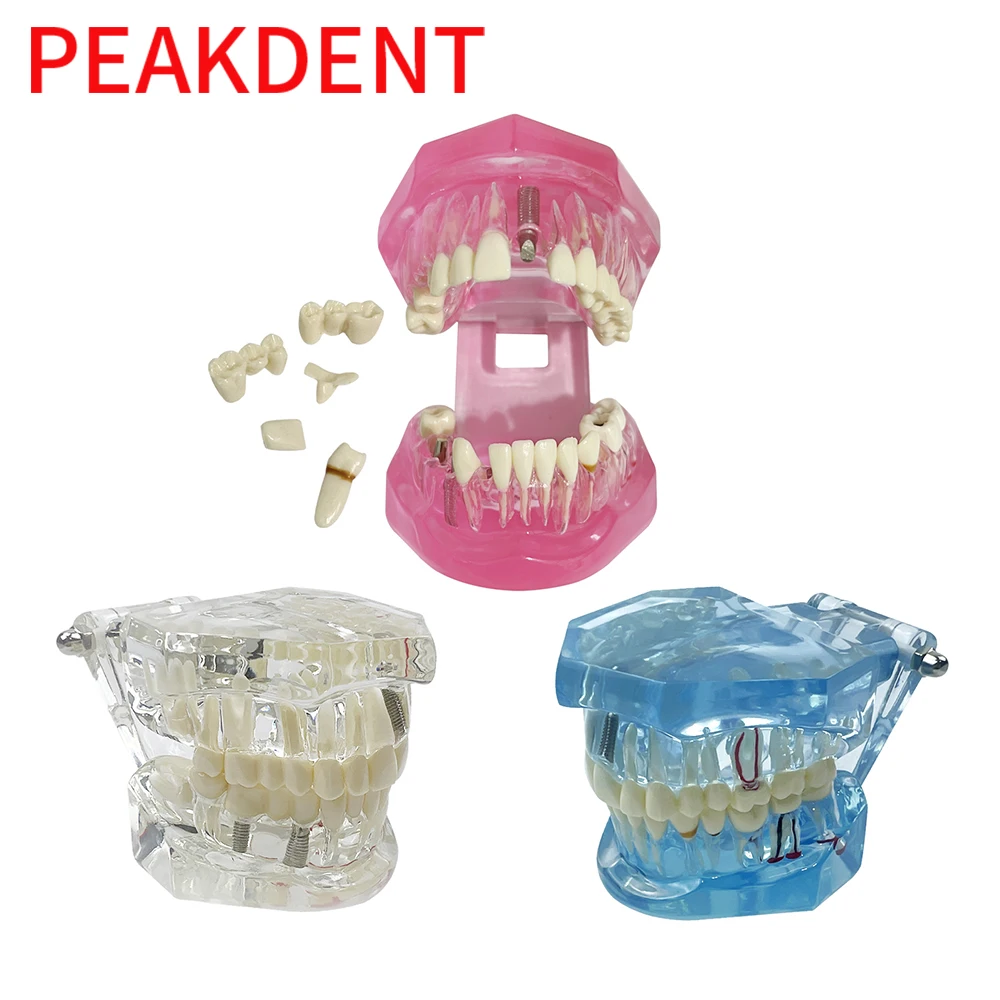 Teeth Model  Removable Disease Teeth Restoration Model for Dentist Student Practice Training Oral Medical Resin Models