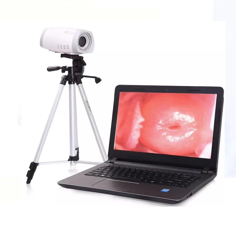 Portable Colposcope digital camera electronic video colposcope OEM Vaginal examination equipment For Gynecology