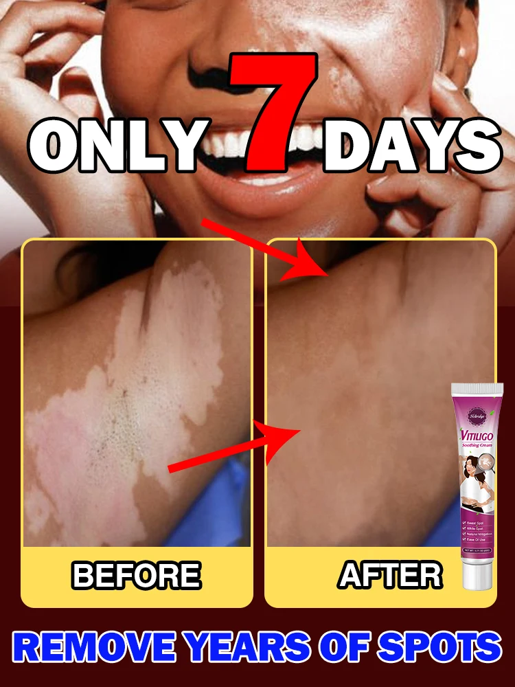 

Effective in 7 days, no longer troubled by white spots, vitiligo patients