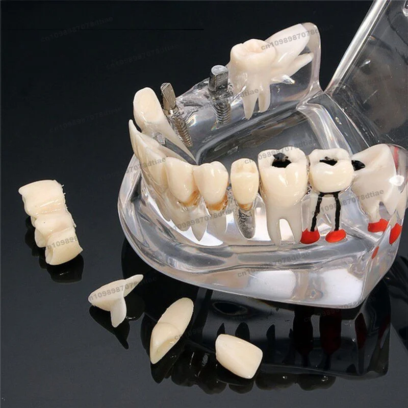 For Dental Materials Bridge Restoration Model Pathological Tooth Model Removable Movable Dental Implant